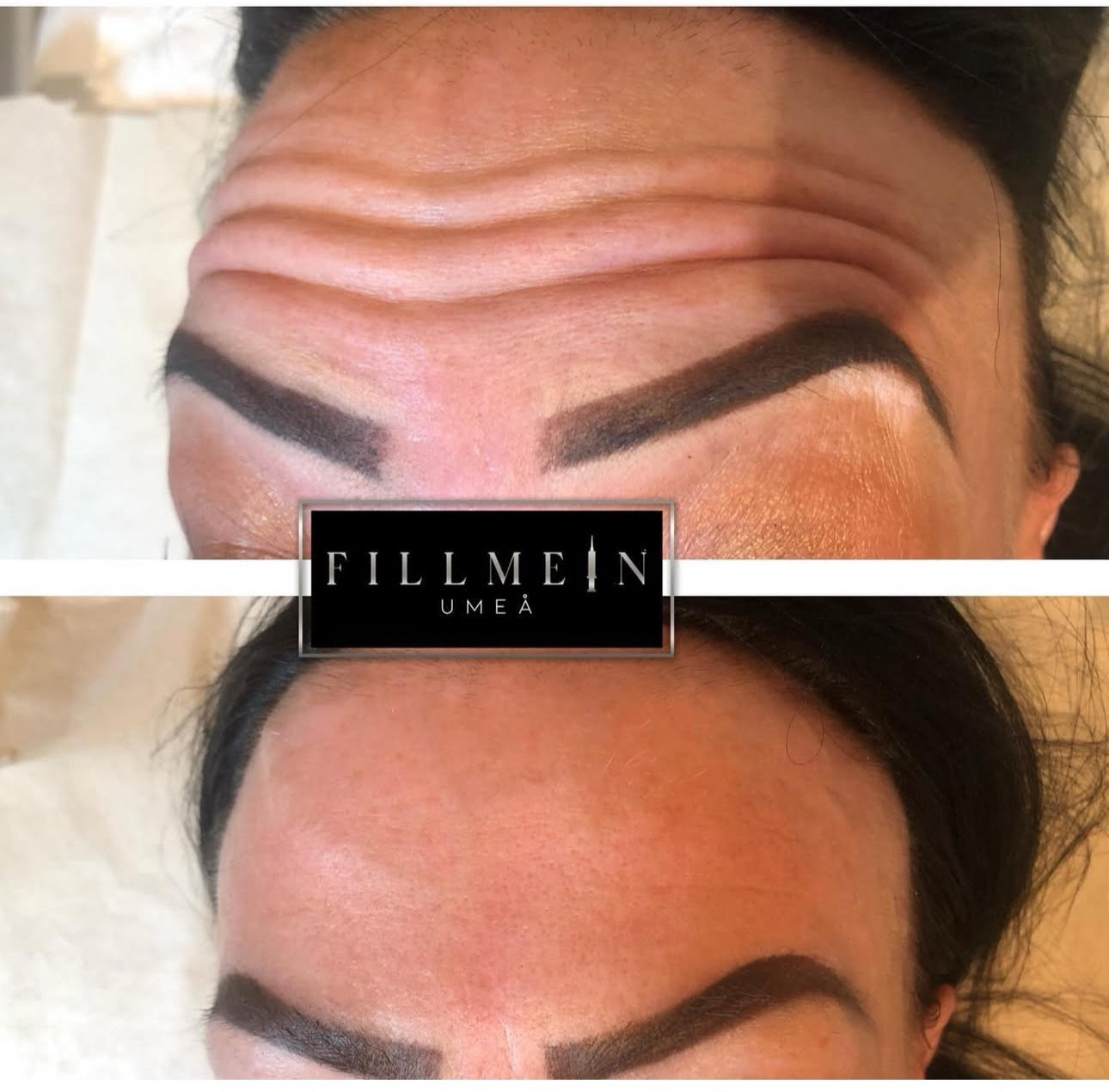 Toxiner/Botox