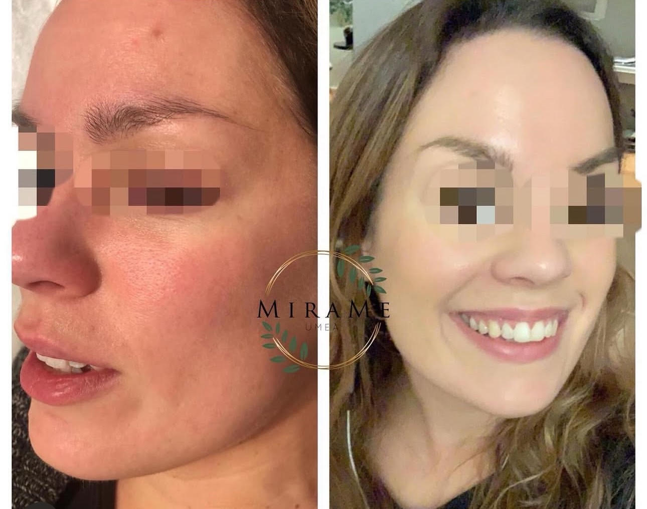 Microneedling