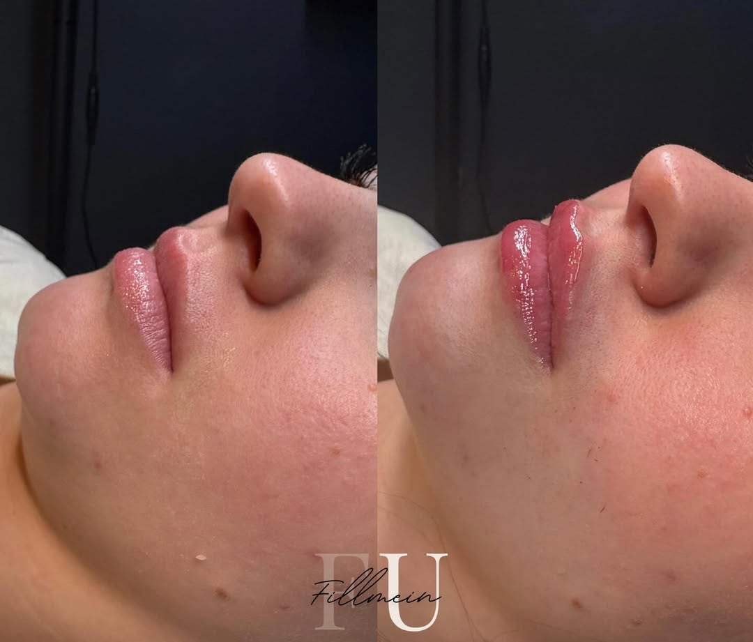 Fillers